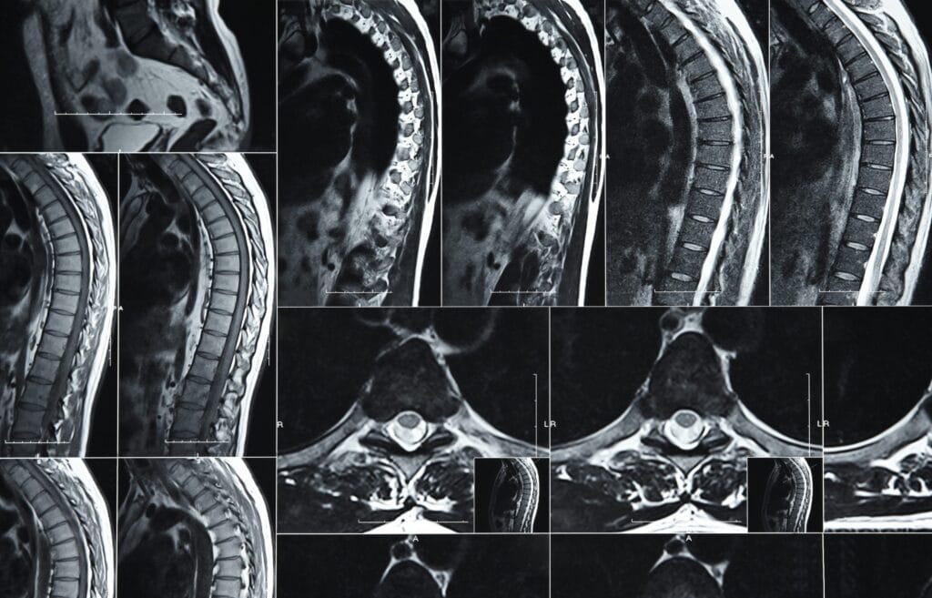 Modic changes on MRI