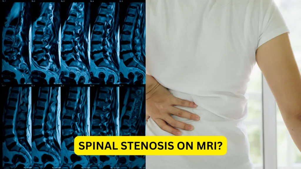 SPINAL STENOSIS ON MRI